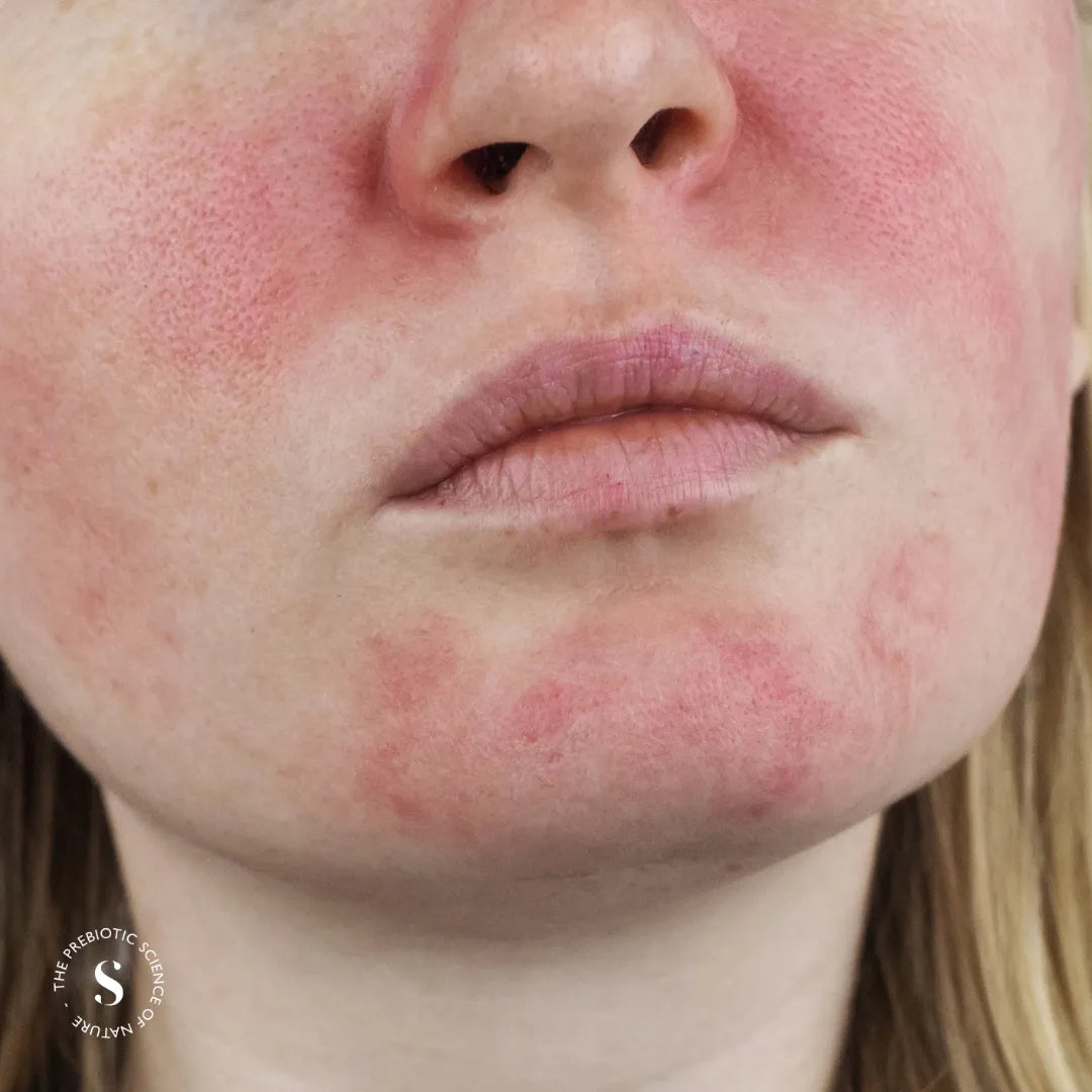 Ratgeber für empfindliche Haut: Was, warum und wie lässt sich ein Ausbruch vermeiden?